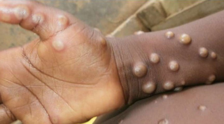 DS&Ouml;&rsquo;den maymun &ccedil;i&ccedil;eği vir&uuml;s&uuml; i&ccedil;in mutasyon a&ccedil;ıklaması